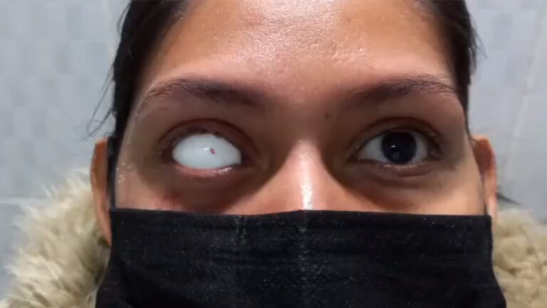 Lee más sobre el artículo Paciente con Perdida bulbo ocular derecho por Úlcera Córneal